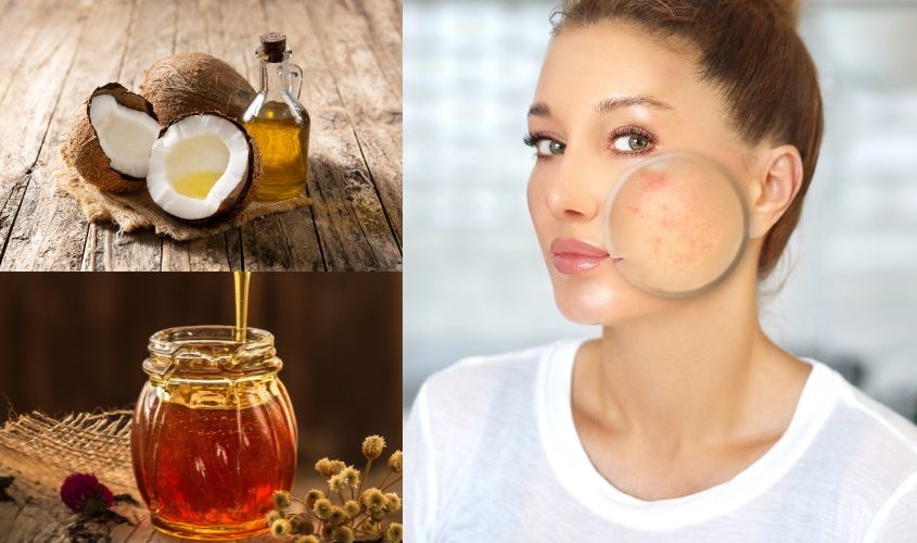 Mặt Nạ Dầu Dừa và Mật Ong