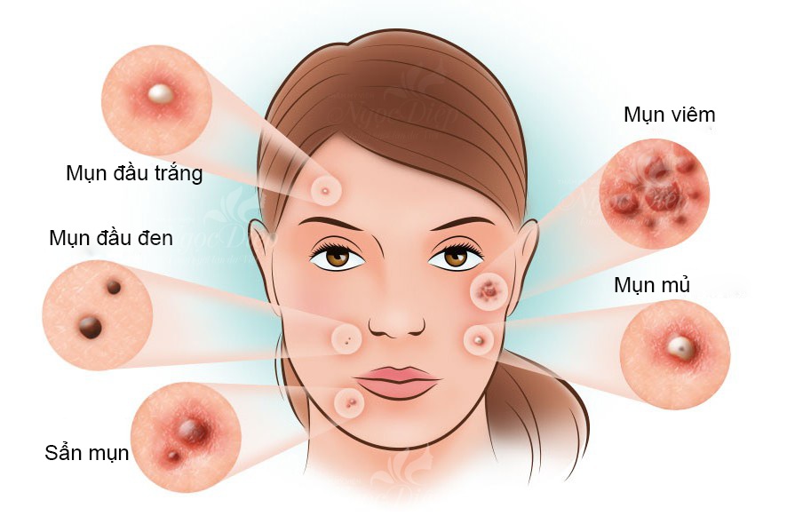 Phương pháp điều trị mụn trứng cá hiệu quả
