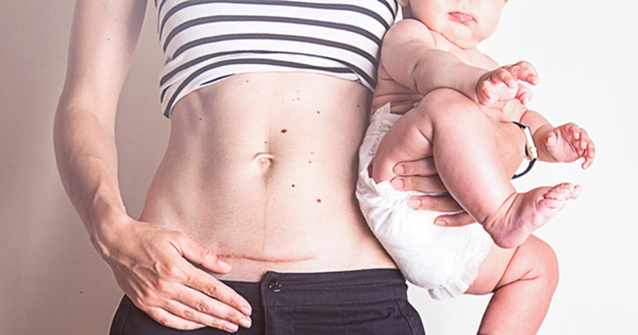 Vẫn biết phần lớn là do cơ địa, thế nhưng làm sao để vết sẹo mổ đẻ