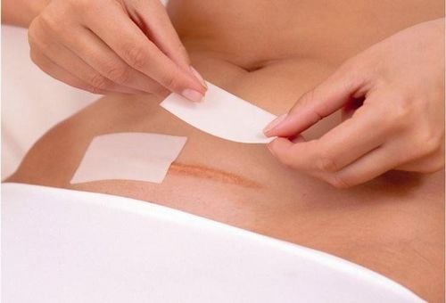 Vẫn biết phần lớn là do cơ địa, thế nhưng làm sao để vết sẹo mổ đẻ